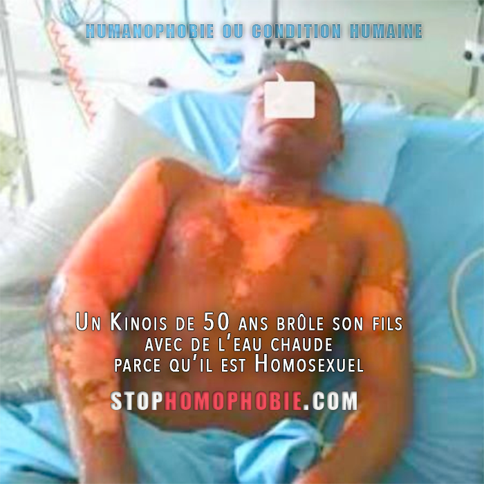 Un Kinois de 50 ans brûle son fils avec de l’eau chaude, car il est Homosexuel