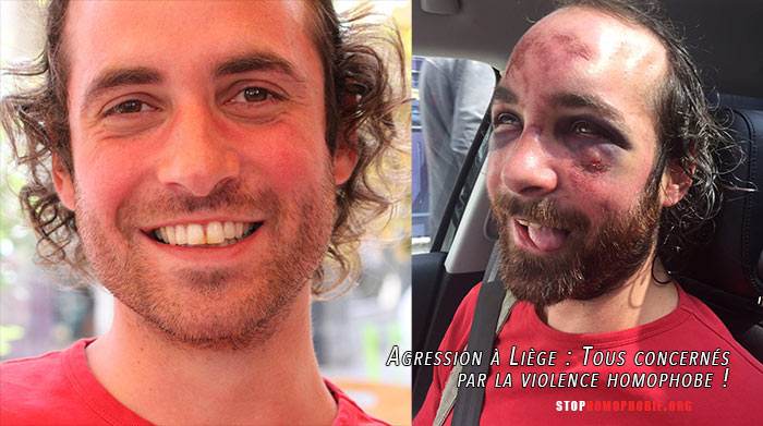 Agression homophobe à Liège : Injures et passage à tabac... la victime défigurée